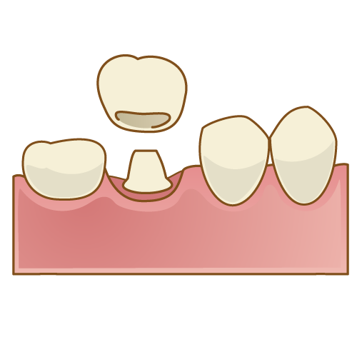 被せ物(クラウン)の種類