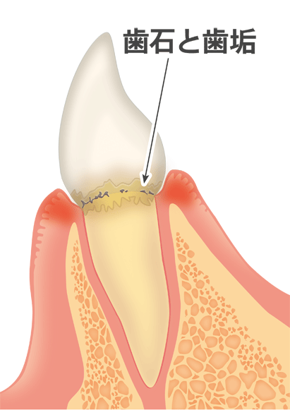 軽度歯周病（歯肉炎・歯周炎）