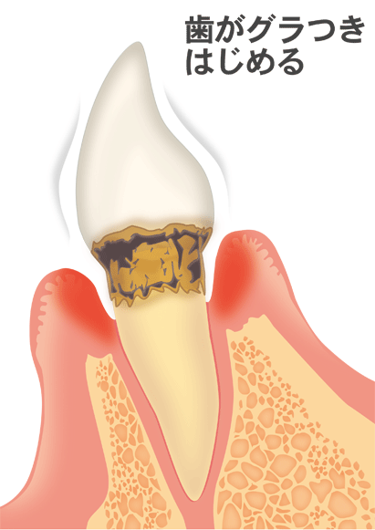 中度歯周病（歯周炎）の場合