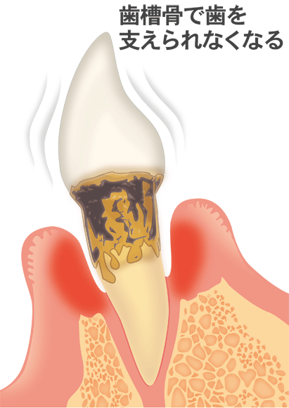 重度歯周病（歯周炎）の場合
